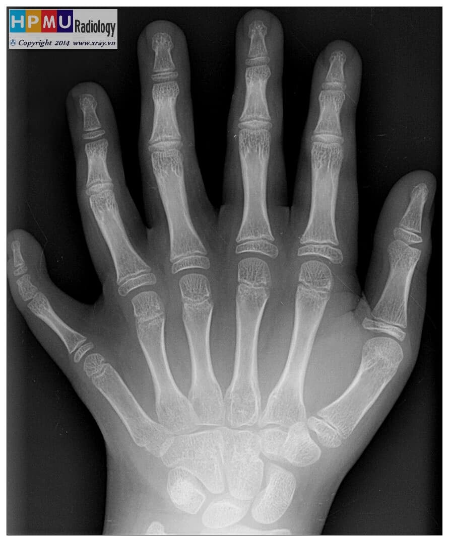 https___upload.wikimedia.org_wikipedia_commons_1_1c_Polydactyly_01_Lhand_AP_Xray.vn