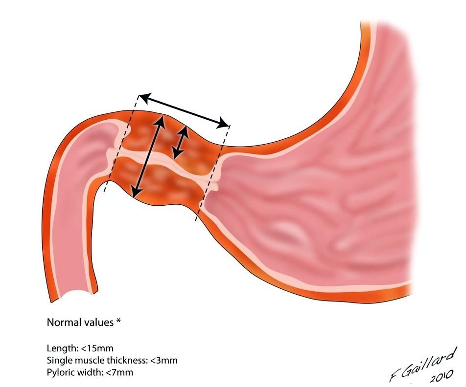 Hẹp phì đại môn vị