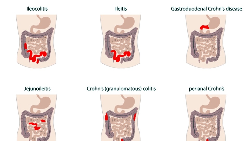 types_of_crohns_disease_og_image_135