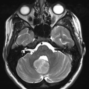 U sao bào nang lông