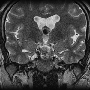 Nang keo não thất