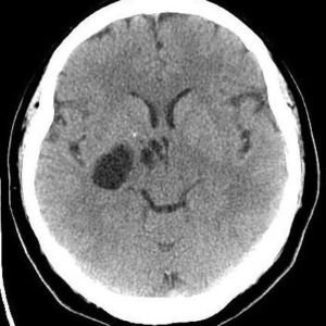 Rộng khoang quanh mạch