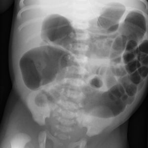 Giãn đại tràng bẩm sinh