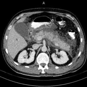 Viêm tụy hoại tử