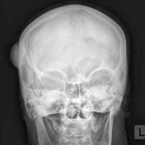 U tế bào tạo xương