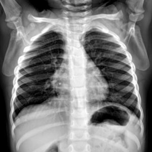 Dị dạng xương sườn