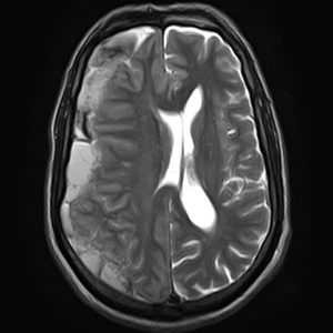 Tụ máu dưới màng cứng