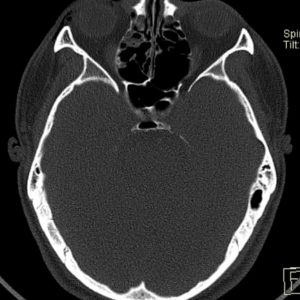Vỡ thành ổ mắt