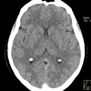 Huyết khối xoang TM