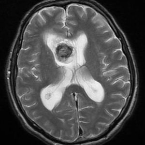 U dưới màng não thất