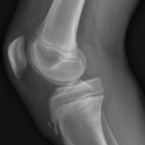 Osgood-Schlatter
