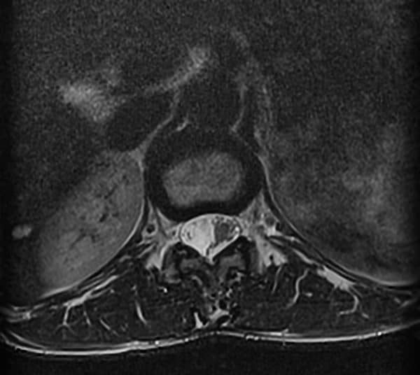 Schwannoma