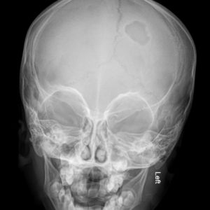 Bệnh mô bào Langerhans