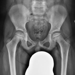 Bệnh Legg-Calvé-Perthes