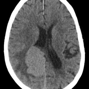 U nguyên bào mạch máu