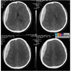 Chấn thương sọ não