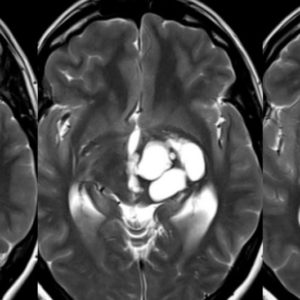 Rộng khoang quanh mạch