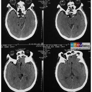 Chấn thương sọ não
