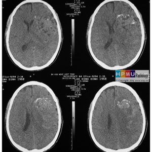 Thông động tĩnh mạch não