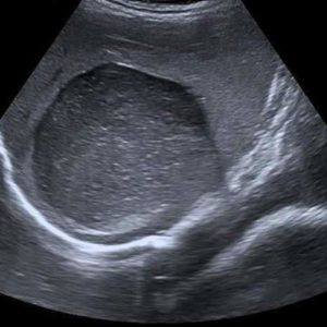 Nang biểu bì lách