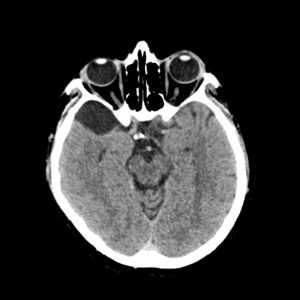 Kén dưới nhện