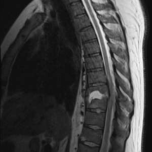Nhiễm trùng cột sống