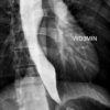 Achalasia - Ảnh 2