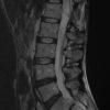 Schwannoma - Hình ảnh 2