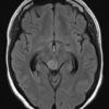 Cavernoma - Ảnh 2