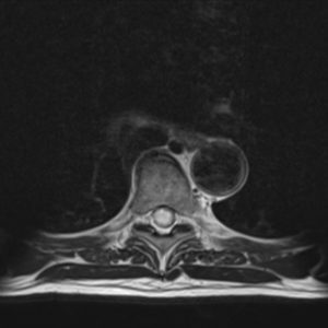 U nguyên bào mạch máu