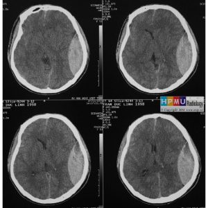 Chấn thương sọ não