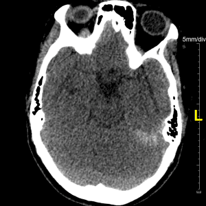 Tụ máu dưới màng cứng