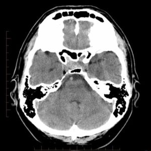 Chảy máu tuyến yên