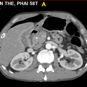 Thủng tạng rỗng