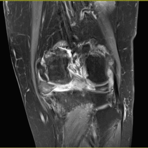 Lồi sụn chêm trong