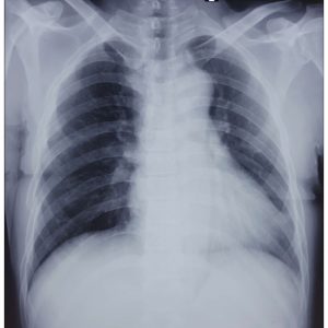 Tràn khí màng phổi