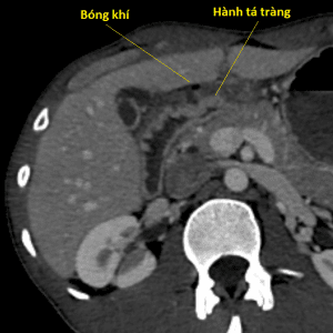 Thủng tạng rỗng