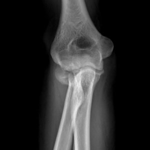 Chấn thương khuỷu tay