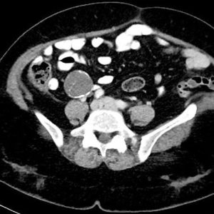 U nhầy ruột thừa