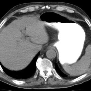 Tắc ruột sỏi mật