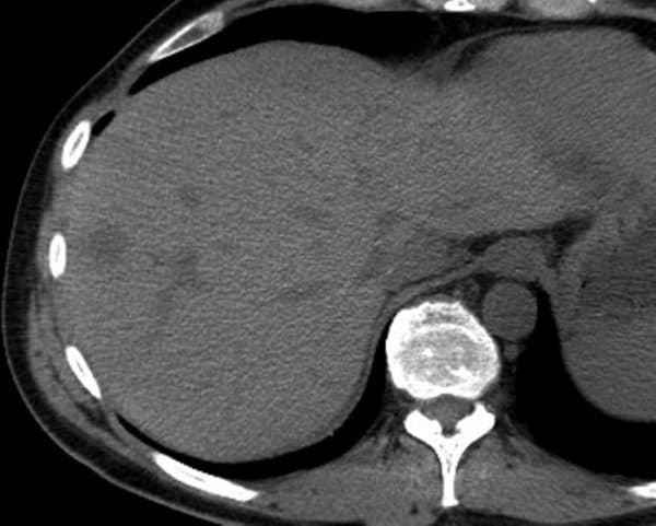 Lymphoma gan