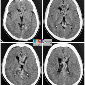 Thông động tĩnh mạch não