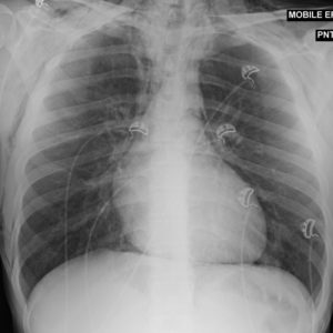 Tràn khí trung thất