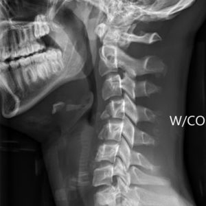 Chấn thương cột sống