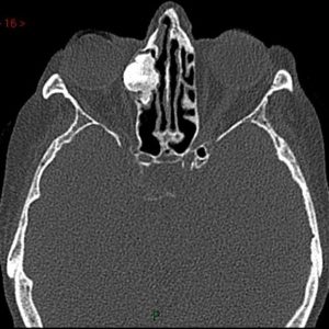U tế bào tạo xương