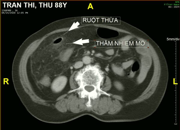 VRT thủng