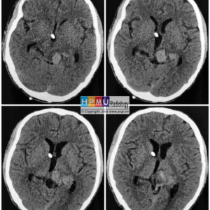 Thông động tĩnh mạch não