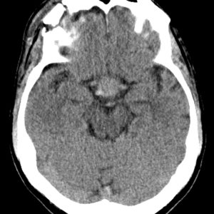 Di căn tuyến yên