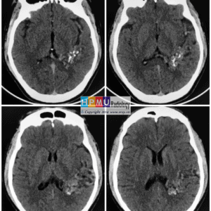 Thông động tĩnh mạch não