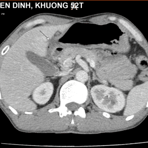 Thủng tạng rỗng